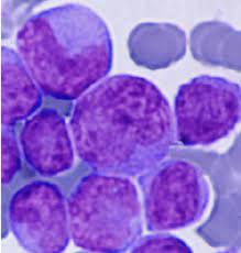 ​Pathology - Acute Myelogenous Leukemia