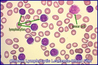 ​Pathology - Chronic Lymphocytic Leukemia 