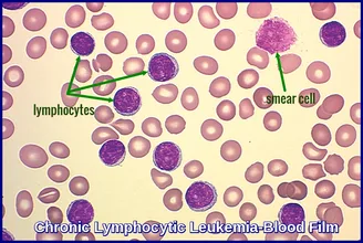 ​Pathology - Chronic Lymphocytic Leukemia 