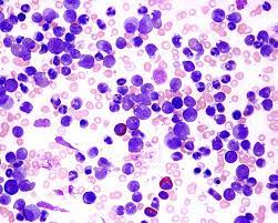 Pathology - Chronic Myelogenous Leukemia (CML)  The Philadelphia chromosome t9;22 is linked to the formation of a hybrid gene ber-abl, which encodes a protein with tyrosine kinase activity. Most commonly observed in individuals of middle age.  Study of the nature and causes of diseases.  Bone marrow: Hypercellular: elevated levels of myeloid progenitor cells Peripheral blood smear reveals leukocytosis characterized by a combination of fully developed and undeveloped myeloid cells.  Presenting Symptoms  The patient has symptoms of low-grade fever, tiredness, nocturnal sweats, and splenomegaly. Laboratory results indicate: The patient exhibits leukocytosis, namely an increase in neutrophils and metamyelocytes. The leukocyte alkaline phosphatase (LAP) is lowered, but the serum B levels are up. Additionally, there is hyperuricemia.   The treatment regimen includes chemotherapy with hydroxyurea and amatinib, a tyrosine kinase inhibitor, as well as bone marrow therapy. Death typically arises as a result of the transition into acute myeloid leukemia (blast crisis). Chronic myelogenous leukemia (CML) is classified as a myeloproliferative condition, which includes polycythemia vera, essential thrombocythemia, and myelofibrosis.