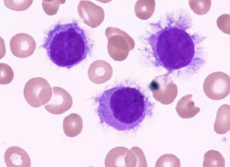 Dermatology - Hairy Cell Leukemia Primarily manifests in males of middle age.  Study of the nature and causes of diseases.  Bone marrow: Presence of hairy cells (B cells with hairlike projections) that exhibit positive staining for TRAP, resulting in interstitial infiltration. Peripheral blood smear analysis: The presence of pancytopenia accompanied by hairy cells.  Presenting Symptoms  The patient presents with significant enlargement of the spleen (splenomegaly) and liver (hepatomegaly), accompanied with symptoms of exhaustion, easy bruising, bleeding, and increased susceptibility to infections.  Therapy  Highly responsive to chemotherapy and other substances, such as 2-chlorodeoxyadenosine. In extreme instances, it may be advisable to contemplate splenectomy.    Additional types of T-cell leukemias/lymphomas include the cutaneous T-cell lymphoid neoplasms (mycosis fungoides and Sézary syndrome), which are distinguished by the presence of abnormal CD4 T cells with cerebriform nuclei, and adult T-cell leukemia/lymphoma, which is linked to HTLV-1 infection.