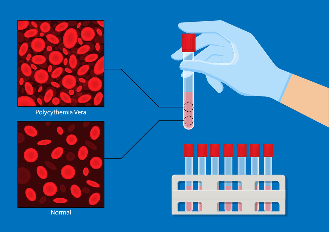 Pathology - Polycythemia Vera  Polycythemia Vera is a medical condition characterized by an abnormal increase in the number of red blood cells in the body.  Myeloproliferative disorder is a condition where there is abnormal growth of blood cells. In 95% of instances, this disorder is linked to a specific genetic mutation called JAK2V617F. Most commonly observed in males who are middle-aged, overweight, and have hypertension.  Study of the nature and causes of diseases.  Bone marrow: The bone marrow is characterized by a high number of cells, particularly erythroid precursor cells. There is also a rise in other types of blood-forming cells, such as megakaryocytes and myelocytes. The patient presents with splenomegaly, pruritus, symptoms related to increased blood thickness such as headache and impaired vision, venous thrombosis, and bleeding. Laboratory results include elevated hematocrit (Hct) and red blood cell (RBC) count, reduced levels of erythropoietin, elevated white blood cells (WBCs), increased platelets, elevated leukocyte alkaline phosphatase (LAP), increased serum vitamin B levels, and hyperuricemia.  Treatment options include phlebotomy, aspirin, and hydroxyurea in cases of thrombosis.  Polycythemia vera is classified as a myeloproliferative condition, along with essential thrombocythemia and myelofibrosis. Essential thrombocythemia is a condition characterized by an abnormal increase in platelet count (thrombocytosis) and an excessive production of large bone marrow cells called megakaryocytes (megakaryocytosis). This condition typically manifests with both bleeding and the formation of blood clots (thrombosis). Secondary polycythemia is characterized by an increase in the mass of blood cells due to an increase in the production of erythropoietin. This increase is induced by persistent hypoxia, renal illness, or Cushing syndrome.